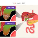 여자 왼쪽 옆구리 통증 이유 무엇일까요 이미지