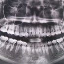 정창희정형외과의원 | <교정일기> : 교정 상담부터 파란 고무줄까지