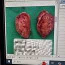 장이비인후과의원 | 역삼하나이비인후과 리얼후기(2) / 혐오주의 - 편도전절제수술(편도제거수술) + 후기 / 통증 / 회복