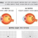 노인성 황반 변성 원인과 증상 건성 습성 주사 치료 이미지