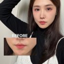 부기1 | 입술필러 1cc 6주차 솔직 후기 (부기 빠진 후 진짜 모양 공개)
