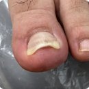 자꾸만 불편해서 부천내성발톱 케어하러 방문한 디에고푸스 본점