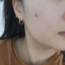 에이플러스 약국 | 여드름 연고 말고 여드름 스팟 크림으로 관리하기