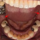 청라밝은의원 | 틀니 탈출! 어금니 임플란트 후기, 일상이 달라집니다.