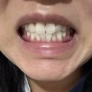 W서울화이트치과의원 | [강남 | 신사] 이 시리지 않은 치아 미백 7일차 후기 ‘레브 치과’