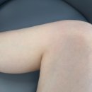 다리 가려움 겨울철 허벅지 간지러움 해결 후기