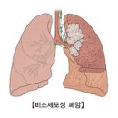 의학과한방(동영상):폐암 (Lung Cancer) 이미지