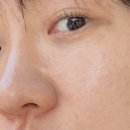 청담 피부과, 바르는 스킨부스터 위코우노+토닝 레이저 효과, 후기