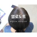 옐로도트/Yellowdot | 대전 서구 smp 옐로도트 정수리 탈모 커버 1회차