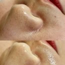 피부피티센터 | 모공/블랙헤드전문 서면에스테틱 추천 피부피티센터 세멘시트관리 후기