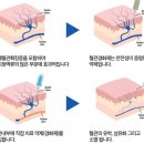 하지정맥류 주사 치료 이미지