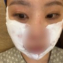 일주카크리닉 | 압구정피부과 울쎄라 리프팅 붓기 3주차 효과 내돈내산
