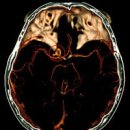 뇌 속의 ‘시한폭탄’ 뇌동맥류 이미지
