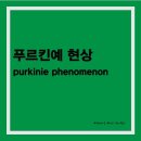 푸르킨예 현상(Purkinie Phenomenon) 이미지