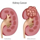 신장암[renal cell carcinoma] 이미지