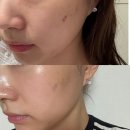 천사약국 | 강남 한의원 여드름흉터 새살침 전후 효과 후기