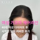 두피를 디자인하는 여자 | 울산여자두피문신 후기 | 다이어트 후 시작된 탈모 어떻게 커버됐을까요? [마이크로청담]
