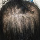 [공지] 대구탈모, 논문·특허로 검증된 한방 탈모치료의 차이