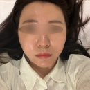 청담스킨 | 청담피부과 포텐자 쥬베룩스킨 후기 쥬베룩스킨 효과
