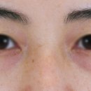꼼꼼성형외과의원 | 눈밑 불룩, 제대로 해결하려면?