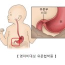 영아 비대성 유문협착증[IHPS (infantile hypertrophic pyloric stenosis] 이미지