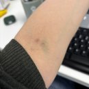 수정-22 | 임신일지22. 인공수정 3차 후기 및 시술 시 통증 최대한 없애는 방법!