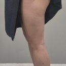 퉁이네 | 허벅지 주사 맞았습니다, 셀룰리스 시술 3주차 하체다이어트 후기