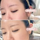 성은의료기 | 잔망루피크림 실비 청구 가능한 피부과크림 리쥬더마 아토로션 MD