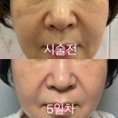 이랑고랑 | 같은 리투오인데 효과가 확실히 달랐던 이유, 50대 엄마 신논현역 피부과 후기
