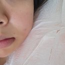디오션치과의원 | [군산 이루다치과] 군산 매복 사랑니 발치 후기(빨리 아무는 방법)
