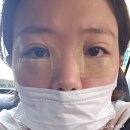 한관종 치료, 내돈내산 치료 후기 목동 고운세상피부과