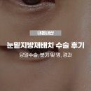 고서약국 | 내돈내산 > 30대 눈밑지방재배치 당일수술 후기 :: 상담 후기, 0~10일차 붓기 및 멍 경과, 다크서클...