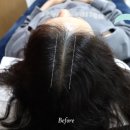 헤아림 동물병원 | 30대 여자 탈모 두피문신 후기