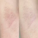 겨드랑이 색소침착, 3주만에 하얘지는 법! 스킨화이트 임팩트 미백바디크림 솔직 사용후기 (Y존,무릎,목뒤)