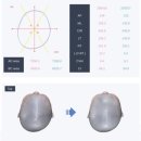 수정위례-D-5 | [아기 두상 교정] 착용 1개월 차, 사두증 교정 헬멧. VIVA 3D(위례점) 교정 헬멧 업체 후기 2.