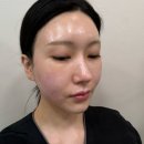 동구 두 번째 학교 | 대구 동구 피부관리 알테온 V리프팅 신암동 끌라르떼 에스테틱 찐후기