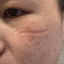 인생1년차 | 얼굴 긁힌 흉터, 흉터제거수술 1년차 후기