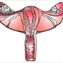 자궁내막증 이미지