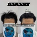 구래동 M자탈모 두피문신후기 추천, 비추천