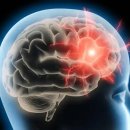 흔한 두통, 시력 감퇴?…뇌종양 의심 증세 이미지