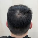 블랭크smp | 주안에서 만난 두피 자신감, 가르마 정수리 smp두피문신 시술 후기