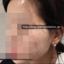 바른성심약국 | 성인 트러블 피부 치료 기록 찐후기 (사용 약물 공개)