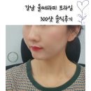 강남 울쎄라피 프라임 300샷 후기 효과 가격 솔직리뷰