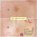 건선 흉터 관리 콜드 플라즈마 1회차 내돈내산 후기, 운정 와이제이뷰티