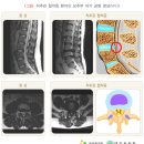 척추관 협착증. 이미지