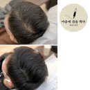 마음에점을찍다두피SMP 이미지