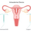 하산부인과의원 | 서초산부인과, 수술이 부담스러운 점막하근종 미레나로 관리하기
