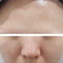 제주필의원 | 제주 노형 피부과] 제주 톡스앤필 포텐자 쥬베룩 네오빔 시술후기 / 톡스앤필 제주점 내돈내산 리얼...