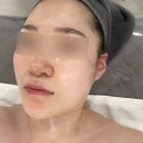 예쁨주의보 | 김해피부관리 LDM물방울레이저 효과 전후 후기 예쁨주의보