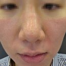 오약국 건너편 | 경기광주피부과 블리비 경기광주점에서 모공관리 카프리레이저 프락셀 제네시스 후기